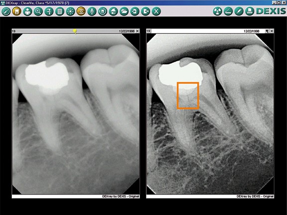 Wand Anesthetic System Dental On Park | Digital X-ray - Dentist Brisbane
