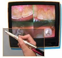 Intra Oral camera Dental On Park | Intra oral camera - Dentist Brisbane