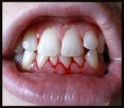 Bleeding Gums?