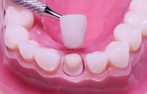 Dental On Park | Dental Crown - Dentist Brisbane