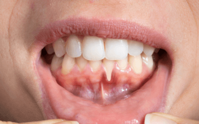 Receeding Gums