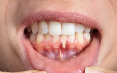 Receeding Gums