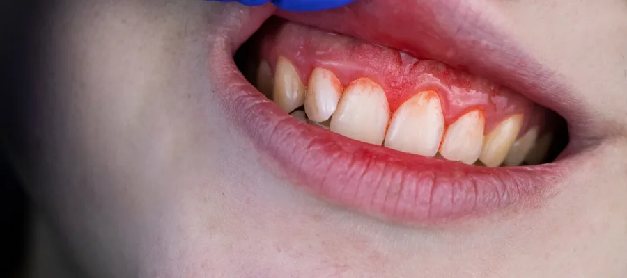 gum disease